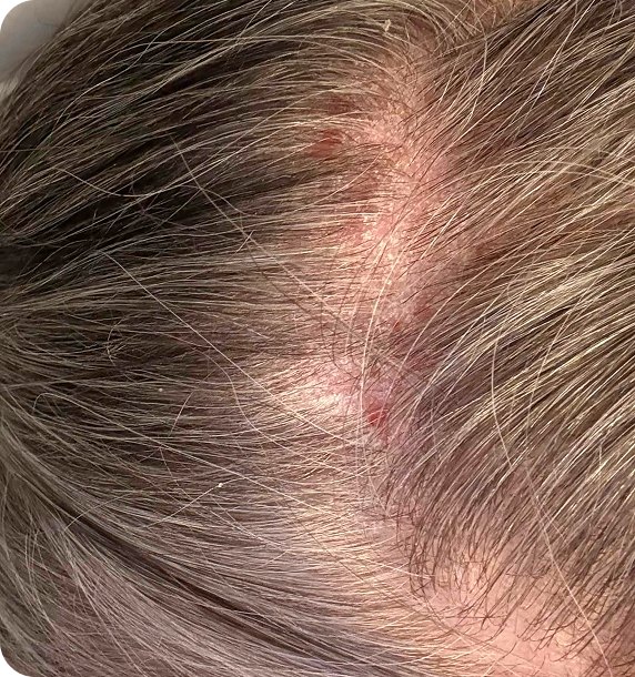 Balanced Scalp, Healthier Hair